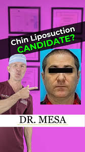 Chin Liposuction By Dr. Mesa