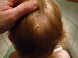 Les croûtes de lait du bébé sont un excès de sébum qui se manifeste sous la forme d'un eczéma sec ou humide. Croute De Lait Bebe 2 Ans
