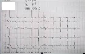 Headache And Sick Sinus Syndrome A Case Report
