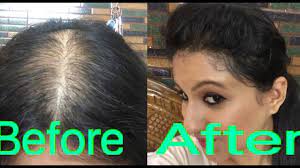 Ultimately reversing the aging process on your head. How To Style Your Hair In Partial Alopecia To Hide Bald Spots Youtube