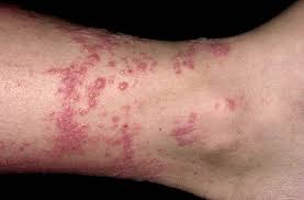 Image result for contact dermatitis