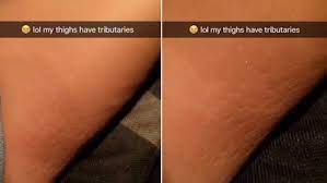 Stretch marks are a type of scar that form below the skin's surface. Chrissy Teigen On Products To Avoid Stretch Marks Daily Mail Online
