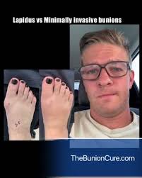 Minimally Invasive Bunion Correction