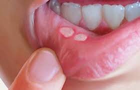 Televen Tu Canal Conoce Que Puede Indicar La Aparicion De Puntos Blancos En Los Labios