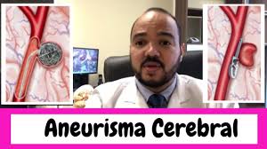 Os nossos vasos são compostos por três camadas de músculos. Aneurisma Cerebral Embolizacao Ou Clipagem Qual O Melhor Tratamento Youtube