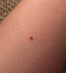 Cherry angiomas is a condition of benign skin growths and if left untreated then sometime it may result in skin cancer. Cherry Angioma Wikipedia