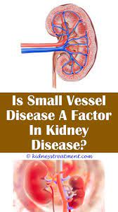 Pin On Kidney Disease Warrior