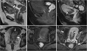 Specialized radiology services in connecticut. Cross Sectional Imaging Of Acute Gynaecologic Disorders Ct And Mri Findings With Differential Diagnosis Part Ii Uterine Emergencies And Pelvic Inflammatory Disease Insights Into Imaging Full Text