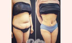Image result for Liposuction