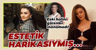 Yaşadıkları estetik operasyonlar ile eski hallerinden eser kalmayan birçok ünlümüz bulunmaktadır. Afilli Ask In Ayse Si Burcu Ozberk Estetik Harikasi Cikti Afilli Ask In Guzel Oyuncusu Burcu Ozberk Eski Hali Ile Cok Sasirtti Galeri Magazin