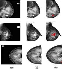 Discuss with your treatment team what clinical trials may be available for your clinical situation. Computer Aided Detection Of Breast Cancer On Mammograms A Swarm Intelligence Optimized Wavelet Neural Network Approach Sciencedirect