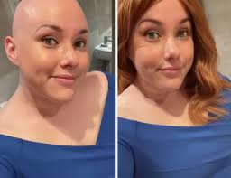 Alopecia: 'I decided I'd had enough of hiding my real self'