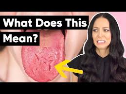 Image result for Fissured tongue