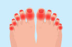12 a drooping eyelid or a drooping mouth can indicate a tumor in the brain stem. Arthritis In Toes Symptoms Causes Diagnosis And Treatment
