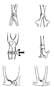 Kielland forceps are probably the most common forceps used for rotation. Forceps Delivery And Vacuum Extraction Glowm