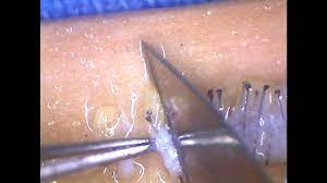 We did not find results for: Follicles Dissected Under Stere Microscope Youtube