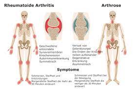 Arthrose Und Arthritis Worin Besteht Der Unterschied Bewegen Ohne Schmerzen