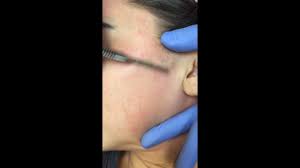 Nina desai and dhara patel to discuss your potential options for reaching your aesthetic goals. Renew Laser Skin Dermaplaning Youtube