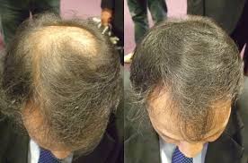 In der tat, nach der american hair loss association, sind entgegen der landläufigen meinung, haarverlängerungen möglicherweise nicht zu einer guten lösung für dünner werdendes haar, wenn sie haarausfall. Dunne Haare Tipps Beim Umgang Mit Dunnem Haar Ursachen Super Million Hair