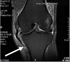 A full tear may require casting or even surgery. Mcl Reconstruction Medial Collateral Ligament Surgery Minnesota