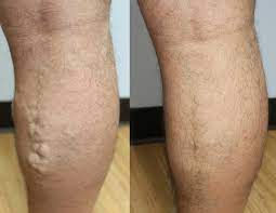 Varicose Veins Laser Treatment Peter Brukasz Md Addison Il Palos Hills Il