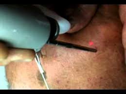 Leurs pathologies peuvent entraîner de grave problème au… Vaisseaux Sur Le Visage Le Nez Traitement Laser Avi Youtube