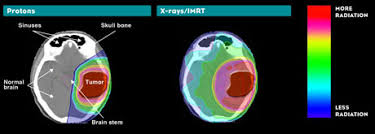 Brain Tumor Treatment Northwestern Medicine Proton Center