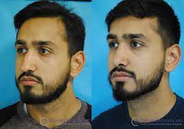 Rhinoplasty Rhinoplasty Nose Surgery Plastic Surgery