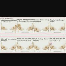 Inflammatory breast cancer symptoms usually start quickly. Inflammatory Breast Cancer Posts Facebook