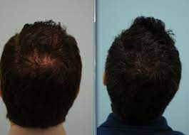 My best friend is a nurse and she frequently gets asked unusual questions. The Young Man Losing Hair An Update On Current Strategies Lam Sam Hairtx Com