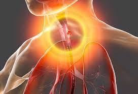 Signs and symptoms of early stage lung cancer. What Were Your First Signs Of Esophageal Cancer