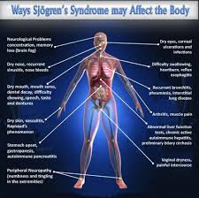Sjogren S Syndrome Support Online Support Group Sjogrens Syndrome Sjogrens Disease Symptoms