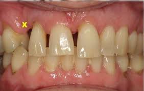 Perawatan saluran akar merupakan bentuk perawatan gigi. Tampal Sahaja Kalau Gigi Tu Berlubang Dentist Ini Kongsikan 6 Kesan Masa Panjang Kalau Korang Terus Cabut Lobak Merah