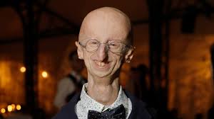 Sammy Basso, Advocate for Progeria Research, Is Dead at 28