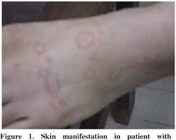 Pdf Autoimmune Progesterone Anaphylaxis Semantic Scholar