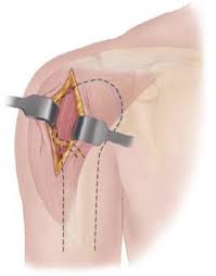 Image result for Traumatic Arthrotomy
