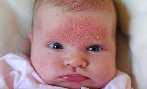 Granos En La Cara En Bebes Y Ninos Causas Y Tratamiento Grano En La Cara Granitos En La Cara Como Quitar Granos