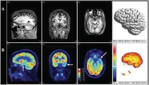 Romans chapter twelve has a similar listing of the gifts of the spirit but i corinthians chapter twelve is more comprehensive in nature. Neuroimaging In Epilepsy Chapter 17 Understanding Epilepsy