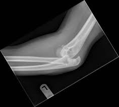Image result for Coronoid Process Fracture