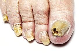 Image result for Yellow nail syndrome feet