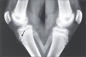 Osgood Schlatter Disease Nejm