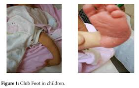 In the most common type, called talipes equinovarus, the heel bends upward and the front part of the foot is turned inward and bent toward the heel. Clubfoot Since Ancient Time Up To Now Omics International