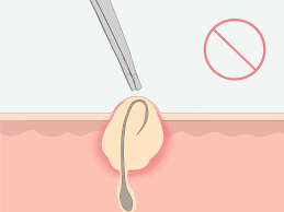 An ingrown hair after waxing happens when the hair never breaks the skin's surface as it grows or does come out of skin first and then grows back into the skin. How To Get Rid Of Ingrown Pubic Hair With Pictures Wikihow
