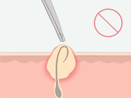 Stop removing the hair in that area. How To Get Rid Of Ingrown Pubic Hair With Pictures Wikihow