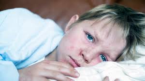 What You Need to Know About Measles