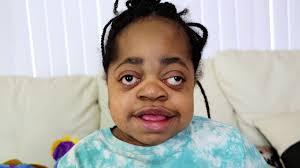 Clara survived a stroke in utero. She is now 17 years old and diagnosed  with 12 different disabilities. This makes it difficult for her to connect  with others, but Clara has learned