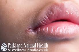 Image result for Angular Stomatitis