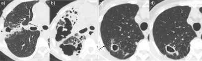 Characteristic Chest Ct Findings For Progressive Cavities In Mycobacterium Avium Complex Pulmonary Disease A Retrospective Cohort Study Respiratory Research Full Text