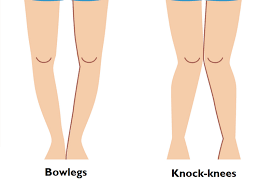 So you want to know how to prevent knee valgus? Knock Knees And Bow Legs Knee Joint Treatment In Nairobi Kenya