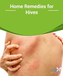 Home Remedies For Hives Apple Cider Vinegar Is One Of The Most Effective Rem Apple Cider Vinegar Remedies Home Remedies For Hives Apple Cider Vinegar Drink